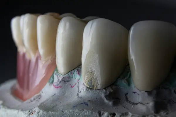 Traitement de caries avec obturations esthétiques